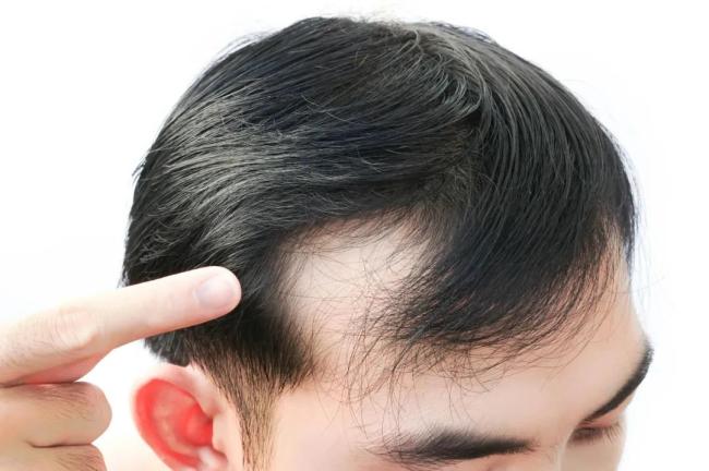 雍禾医疗，种得青丝难解愁